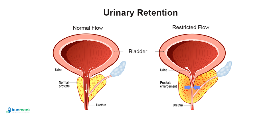 Urinary Retention Causes and Treatment