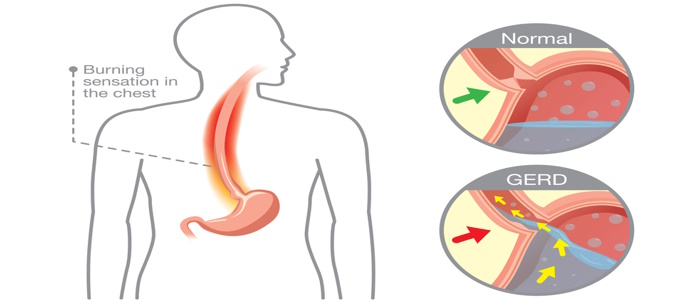 GERD (Acid Reflux): What Is It, Causes, Symptoms and Treatment