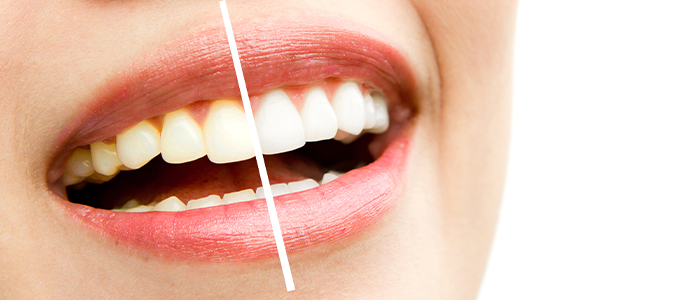 5 Effective Home Remedies For Yellow Teeth