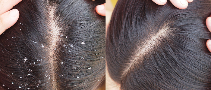 20 Effective Home Remedies to Get Rid of Dandruff Naturally