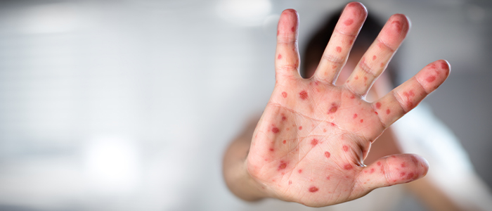 Measles: What is it, Symptoms, Treatment and Prevention