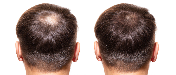 Alopecia Areata: Overview, causes, symptoms and treatment.