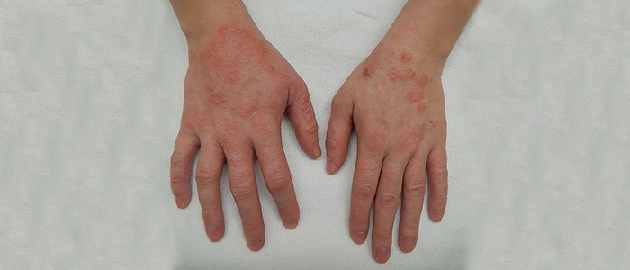 Everything about eczema from causes To treatment