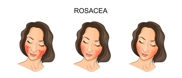 Home Remedies for Rosacea