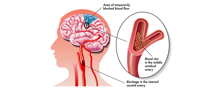 Overview of stroke and its treatment