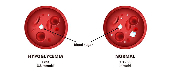 Hypoglycemia (low blood glucose)