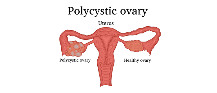 Polycystic ovary syndrome (PCOS) symptoms and treatment