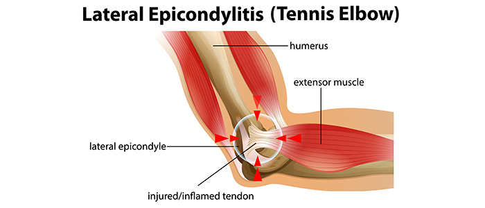 Tennis elbow causes and symptoms