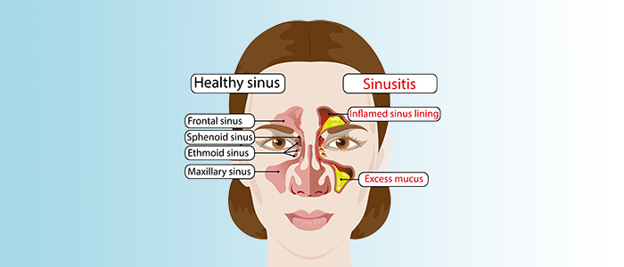 Sinus infection signs and treatments