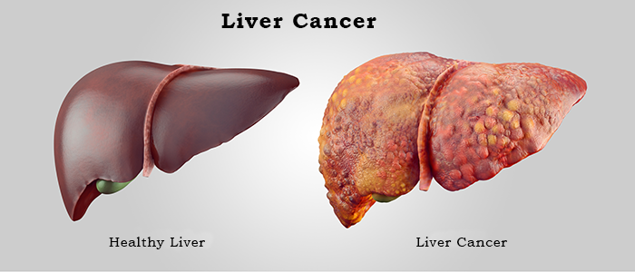 What is liver cancer?