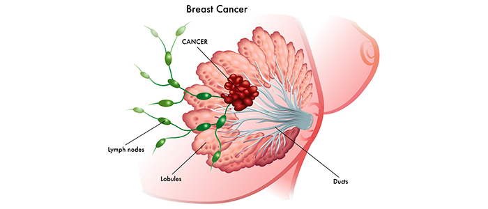 What is breast cancer? A beginners guide