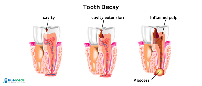 Cavities in teeth: What to do about it?