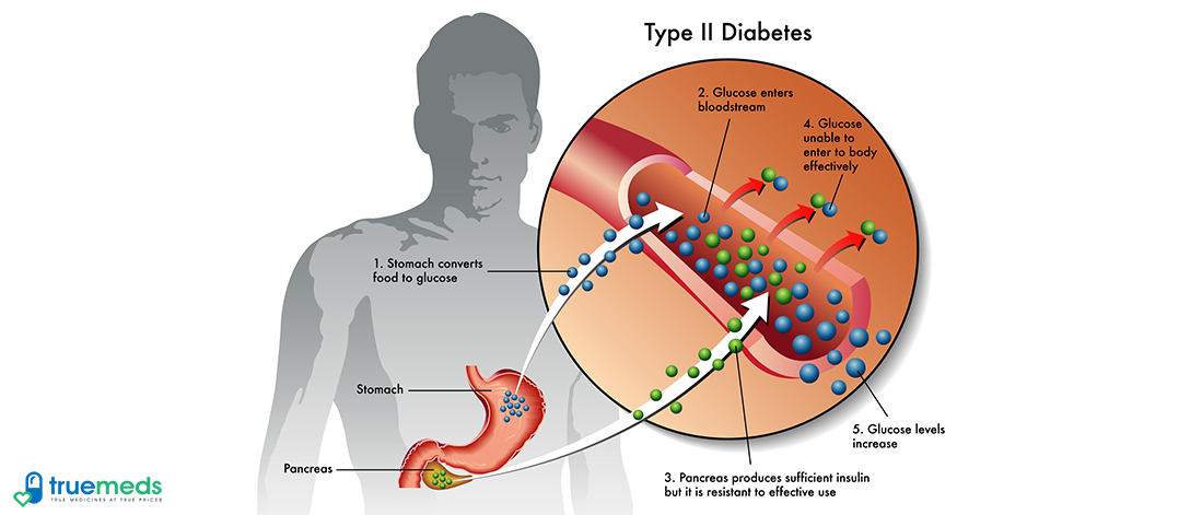 Type 2 Diabetes Causes, Symptoms and Treatment