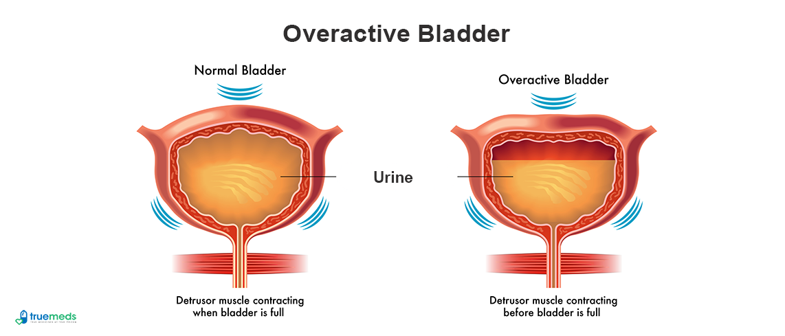 Overactive bladder causes and treatment