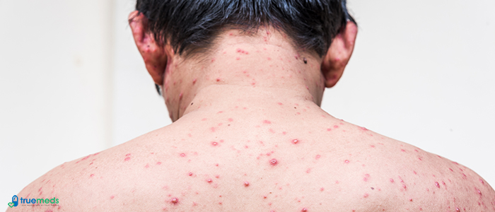 Chickenpox (Varicella) symptoms and treatment