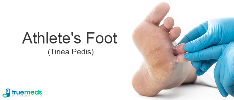 Athletes foot- A fungal skin infection
