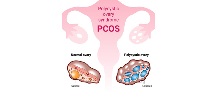 Effective Home Remedies for PCOS