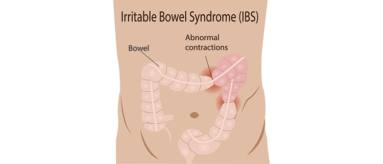 The Role Of Diet And Nutrition In Managing IBS (Irritable Bowel Syndrome)