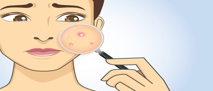Quick Tips for Acne Treatment